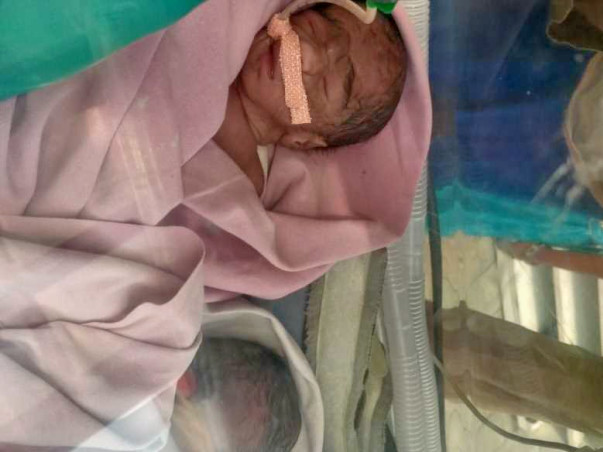 Help My Brother's Twin Babies Suffering LBW