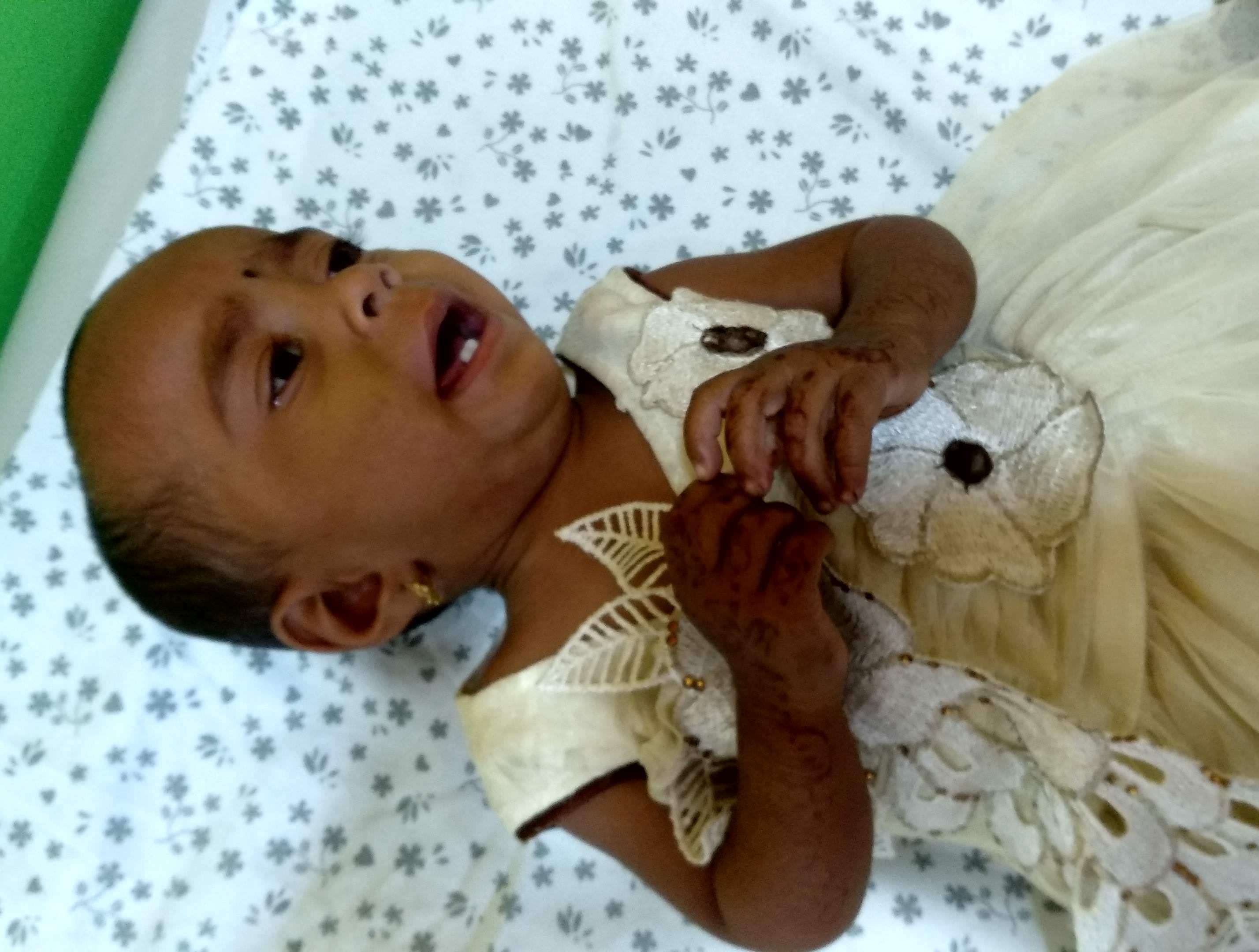 This Baby Has A Rare Birth Defect That Is Killing Her From Inside Milaap