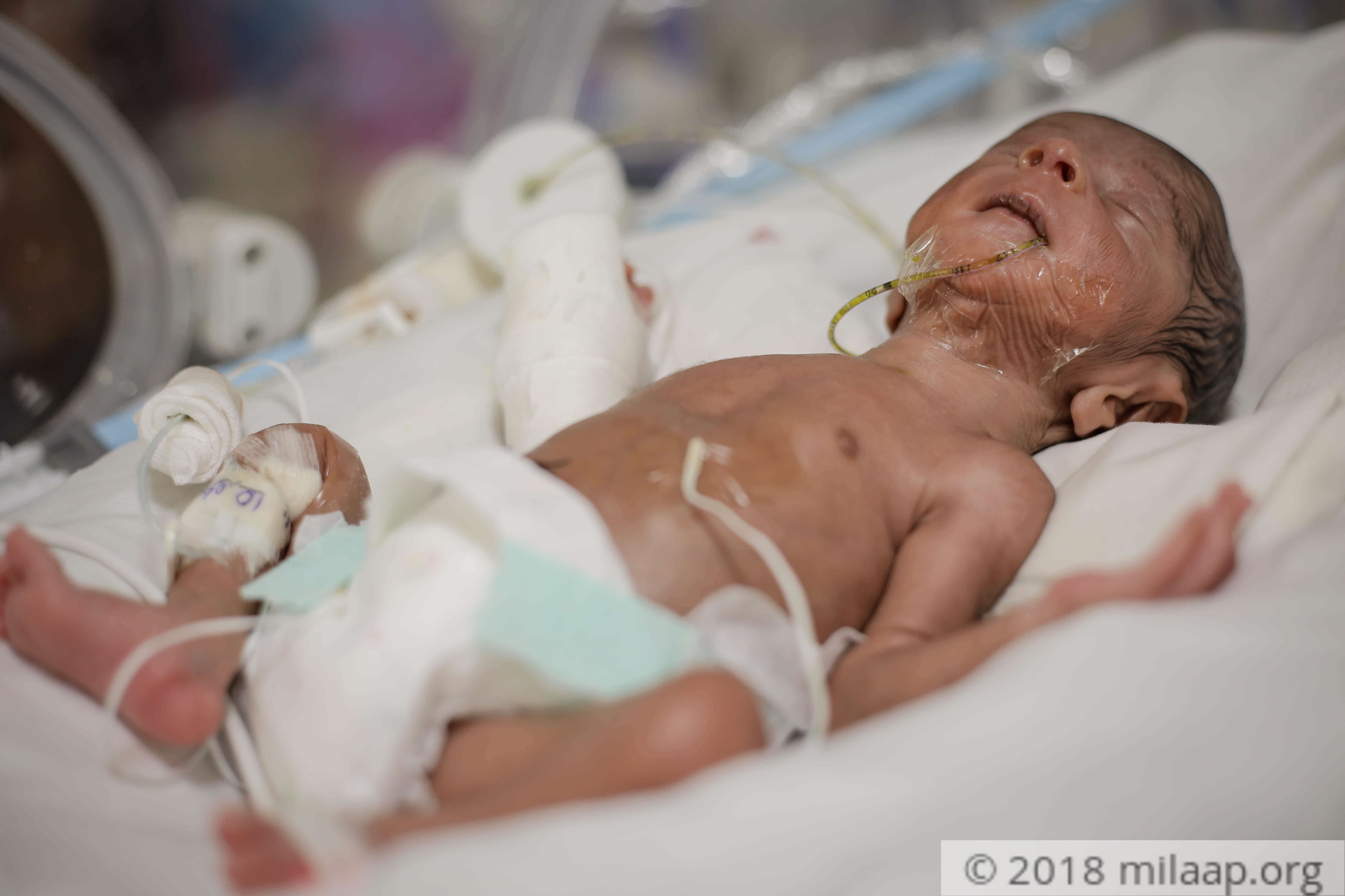 16DayOld Baby Born With A Hole In His Stomach Can Only Feed Milaap