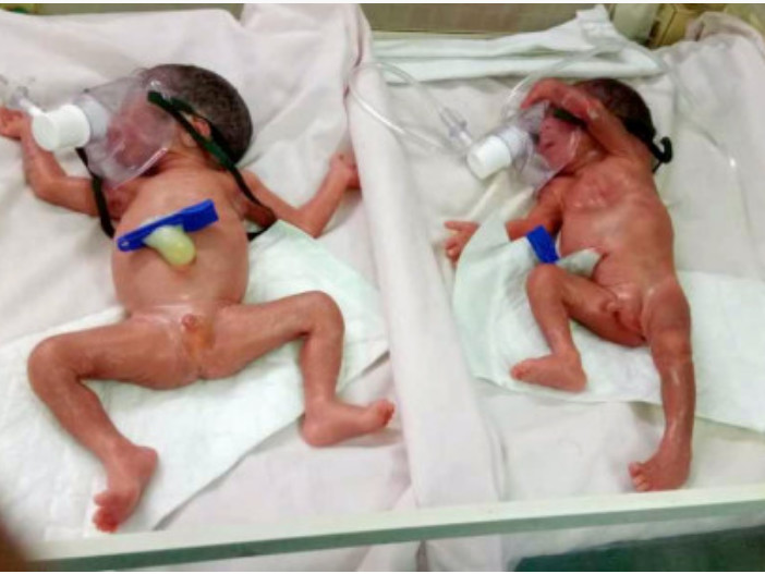 premature baby on ventilator